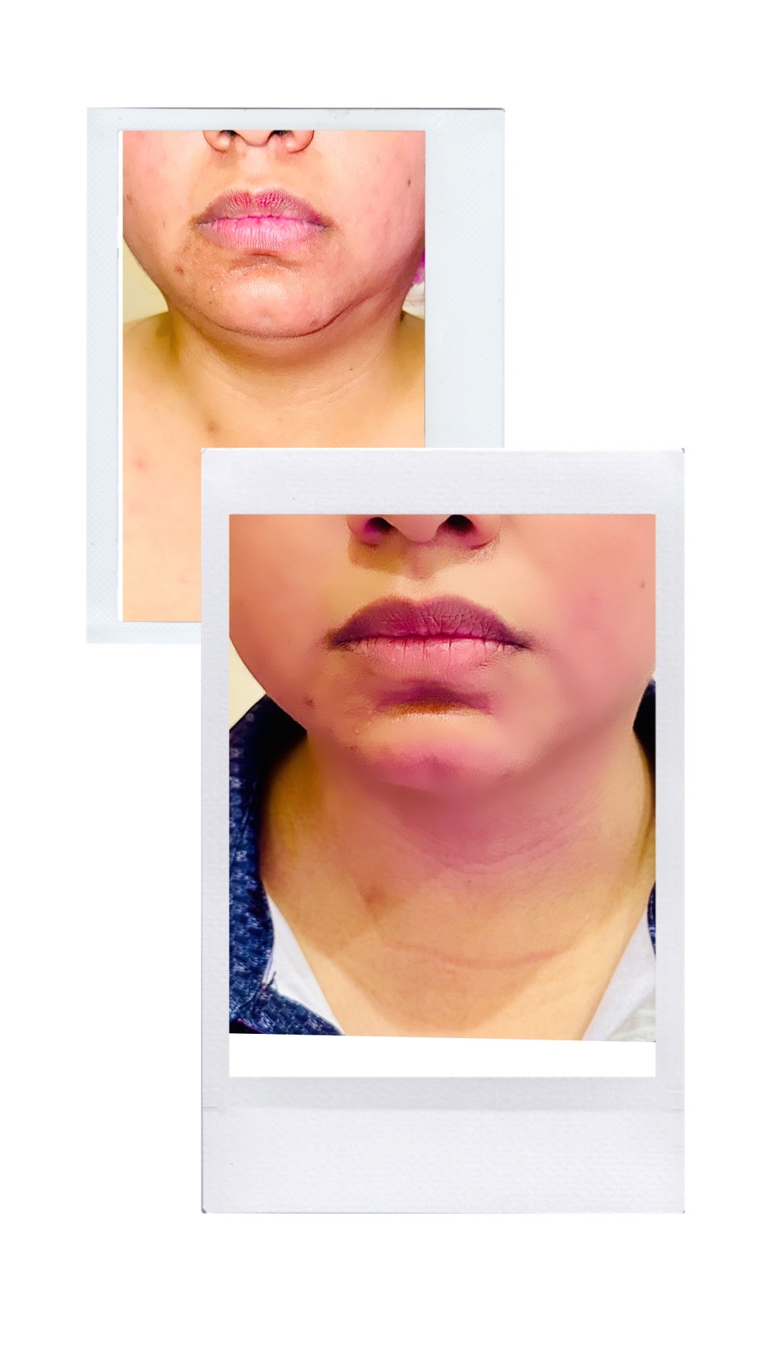 RF SKIN TIGHTENING