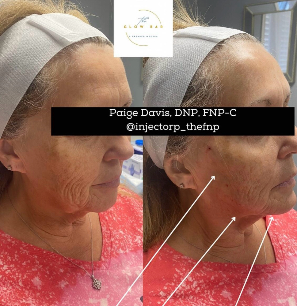 PDO Thread Lift: Midface