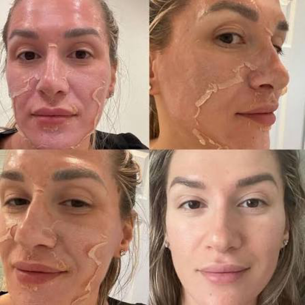 Perfect Derma Peel at Liv For Aesthetics in Tempe, AZ
