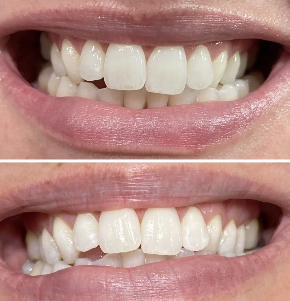 MAINTENANCE WHITENING SESSION