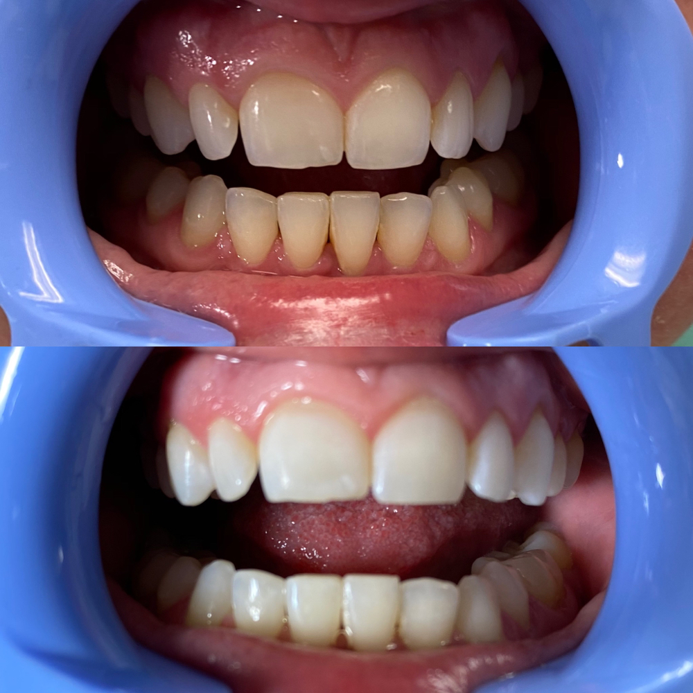 60 Min Teeth Whitening