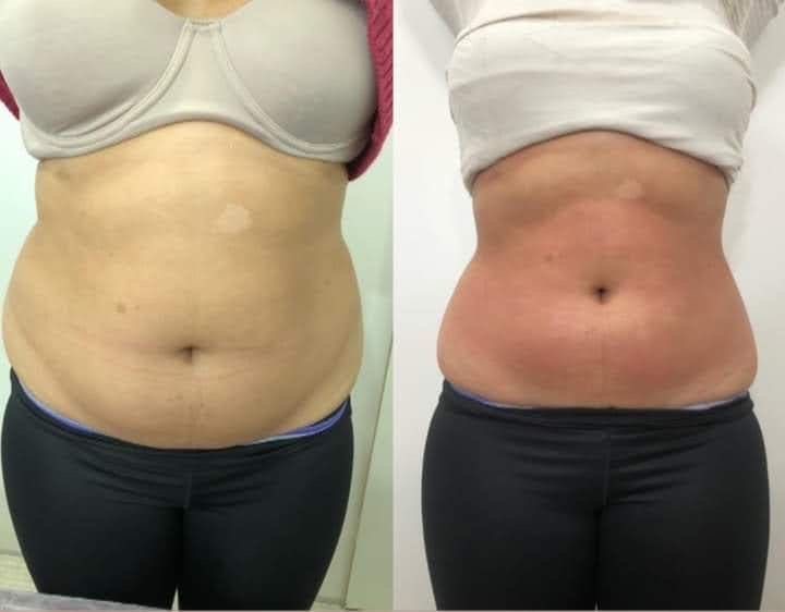Lipo/Fat Dissolver