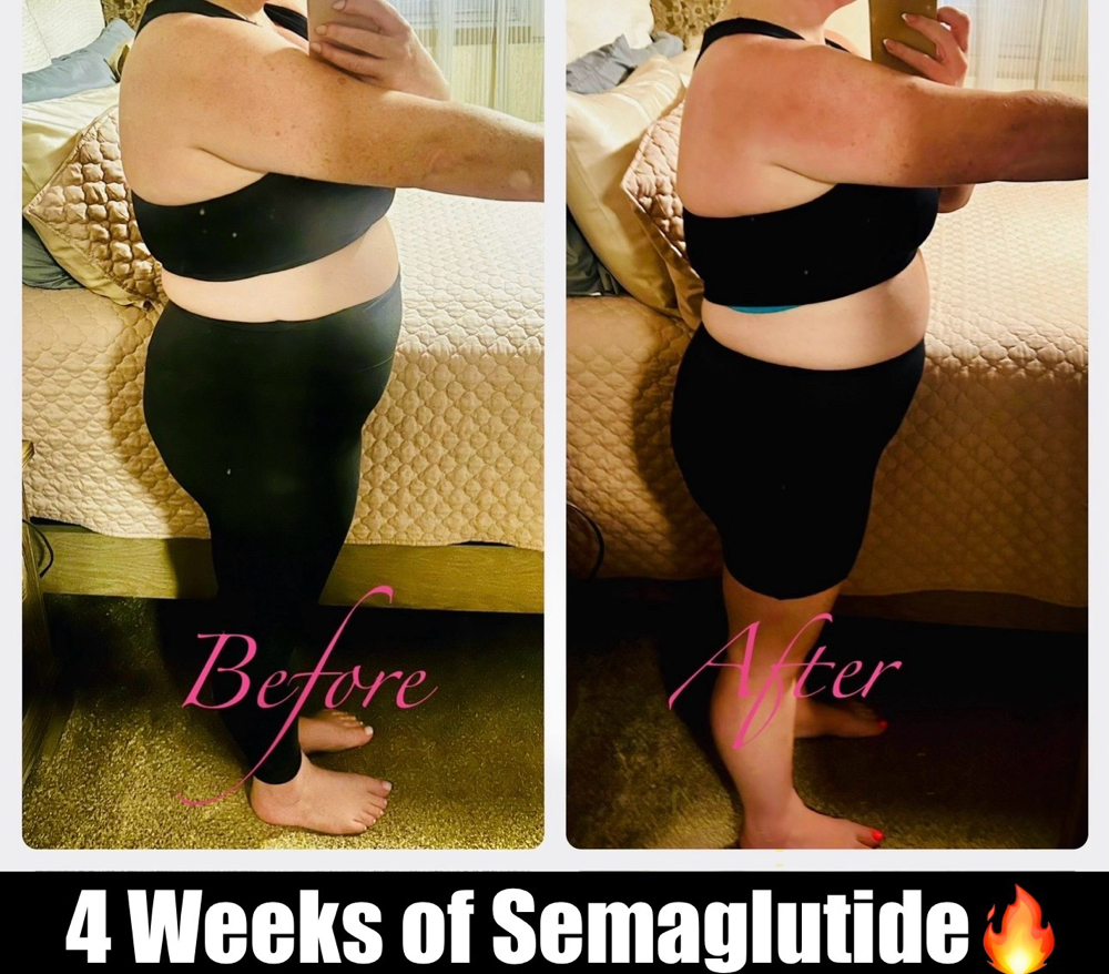 Monthly Semaglutide