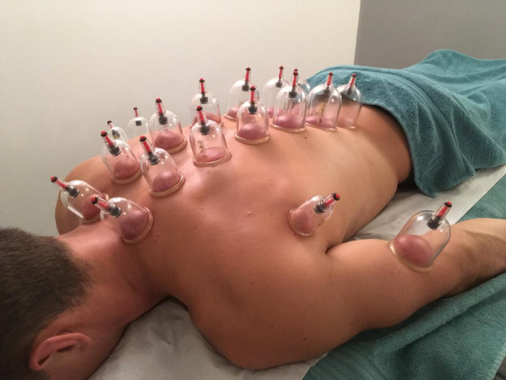 Cupping Therapy
