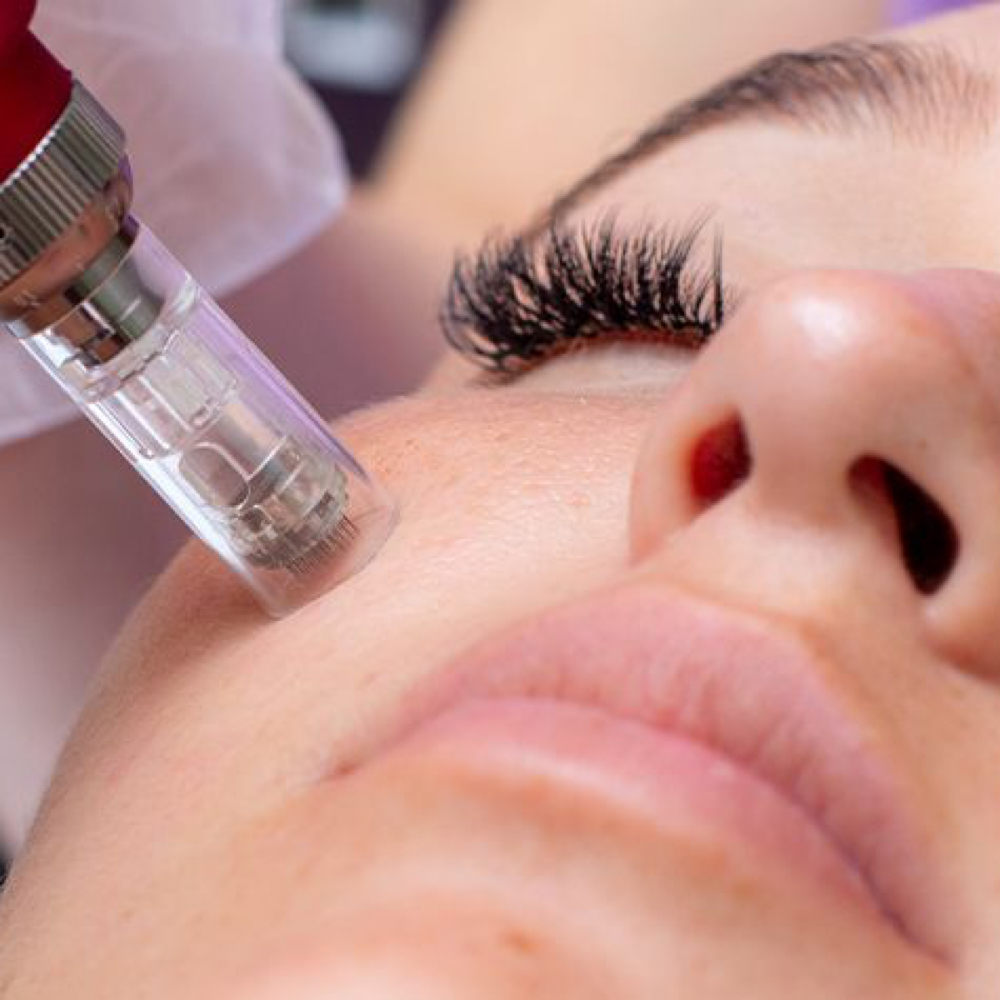 Nanoinfusion Facial at Face to Face Esthetics in Fort Oglethorpe, GA