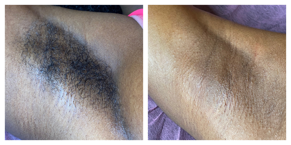 Underarm Sugaring