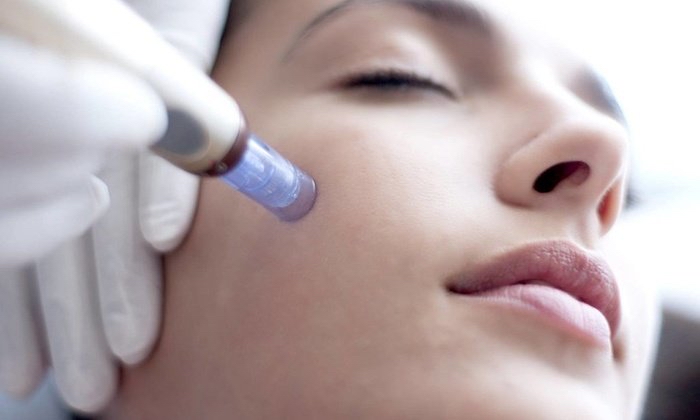 Micro Needling Facial