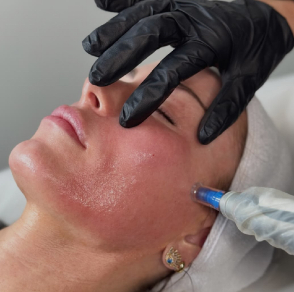 Microneedling With PRF at ReGenerations Medi Spa in Radcliff, KY