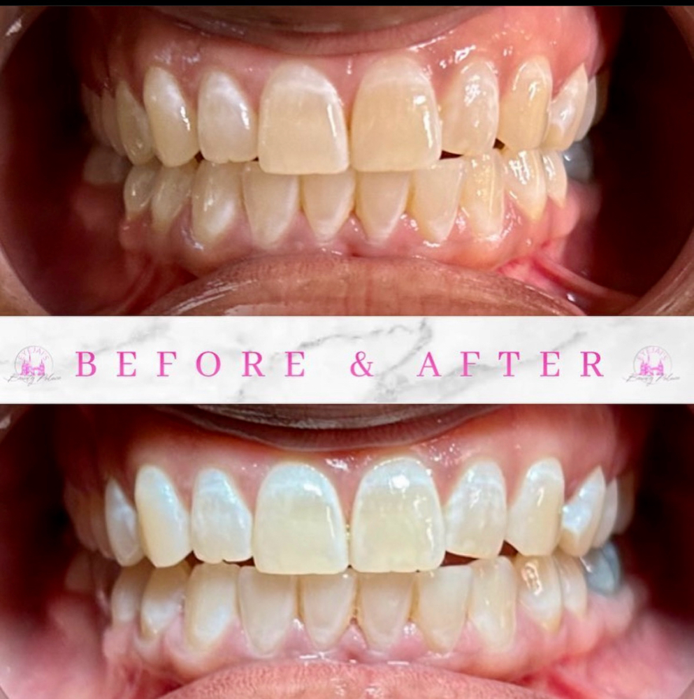 Cosmetic Teeth Whitening