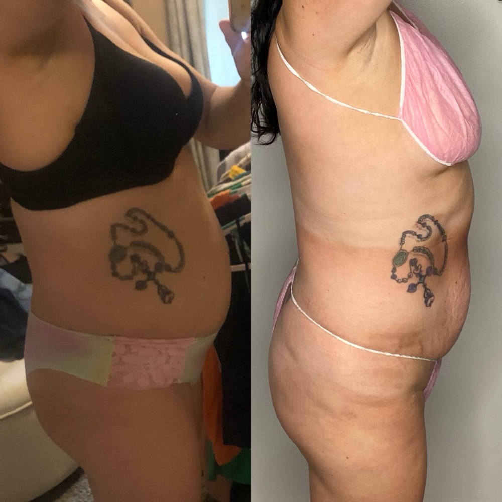 Waist Slimming Session at LuxBeautique in Pawtucket, RI