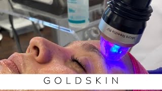 Microneedle RF Goldskin (1)