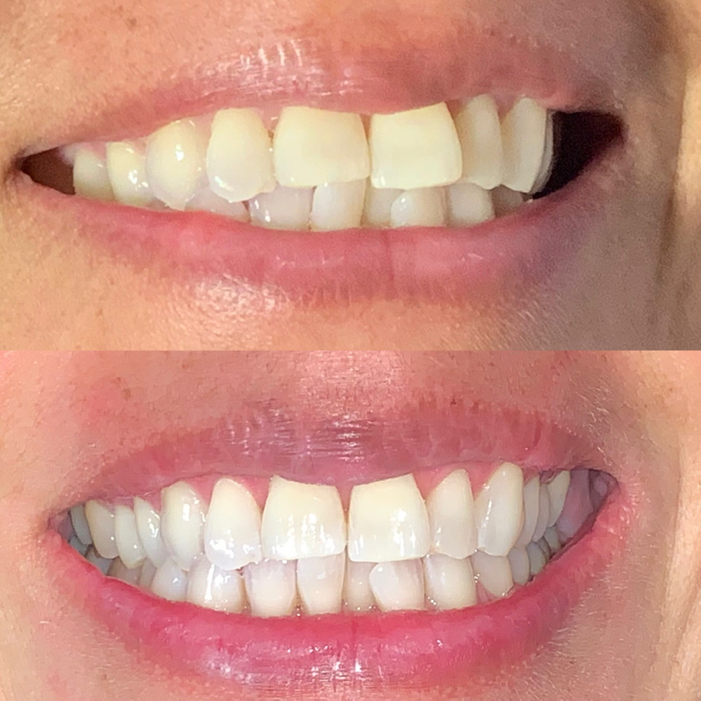 Teeth Whitening