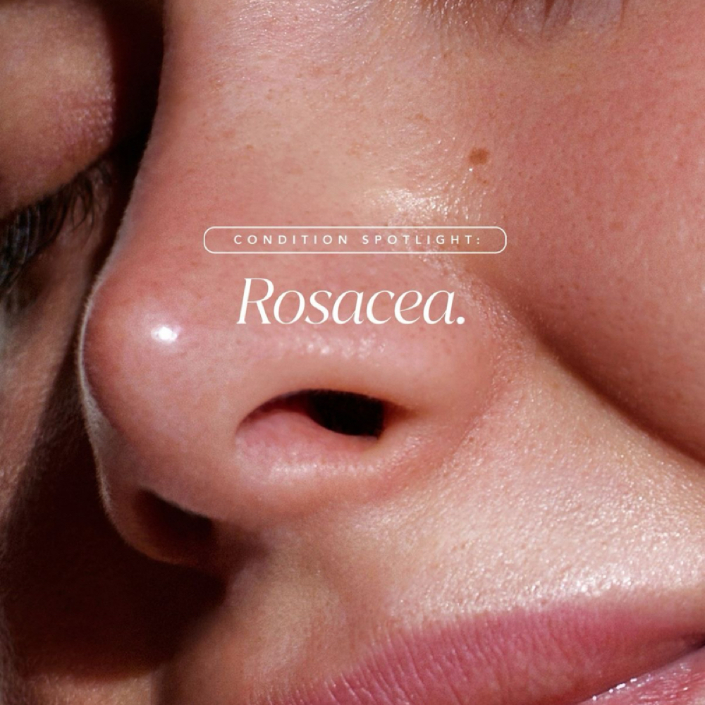 Rosacea Facial at Blessed Beauty Aesthetics, LLC in Houston, TX