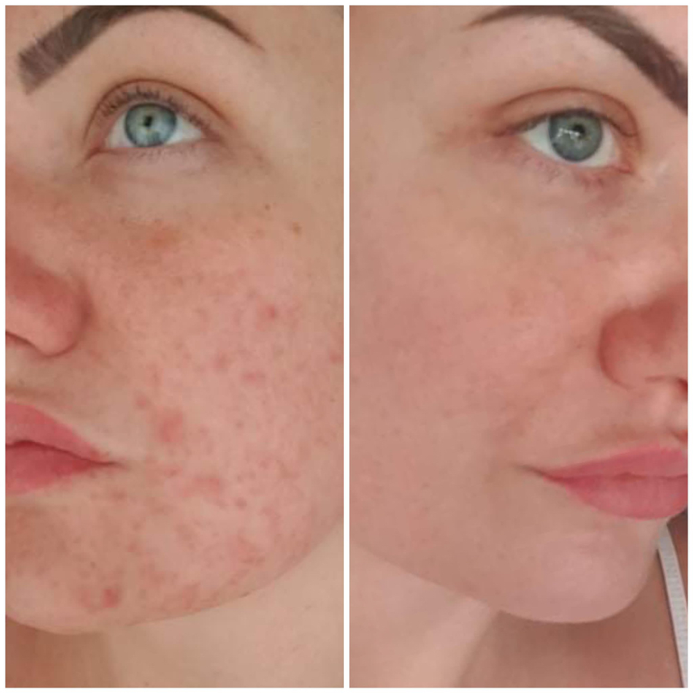 BioRePeel Facial