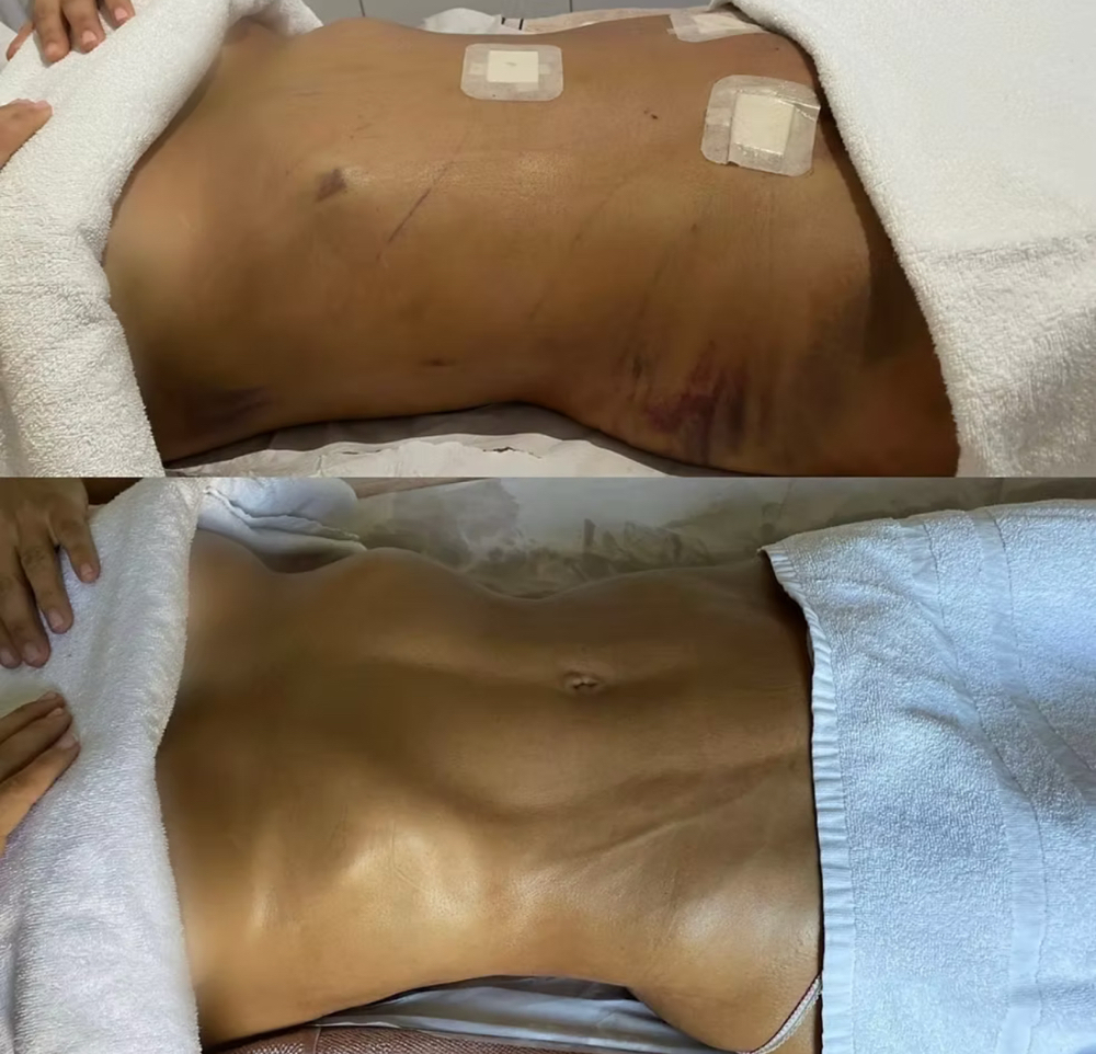 Postoperative Lymphatic Drainage at Myp Skin & Body LLc in Columbia, MD