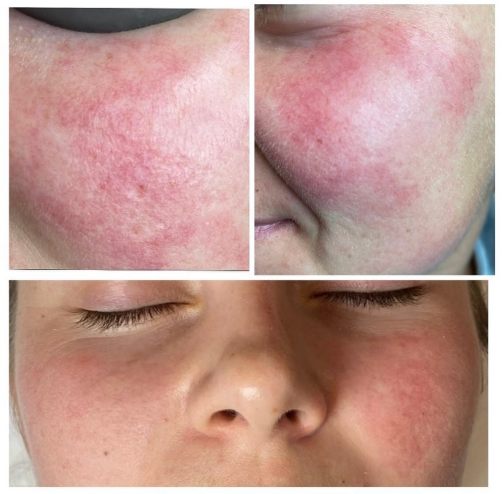IPL Photofacial
