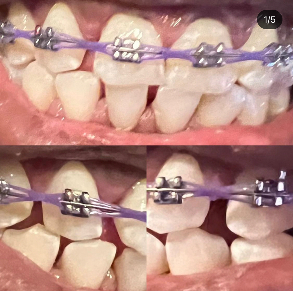 Full Set Braces