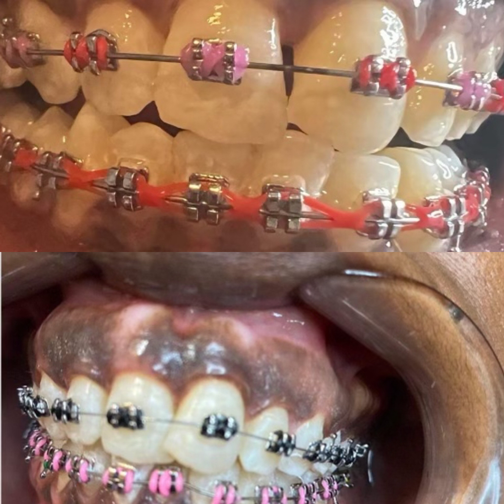 Color Change/tightening