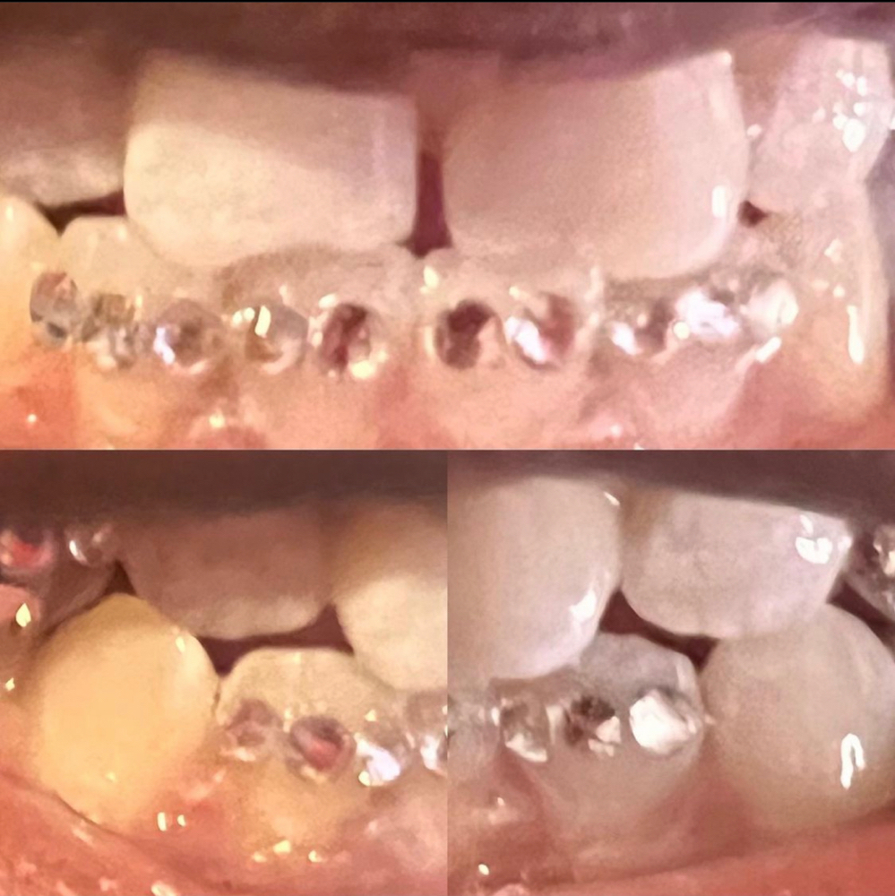 Teeth Gems