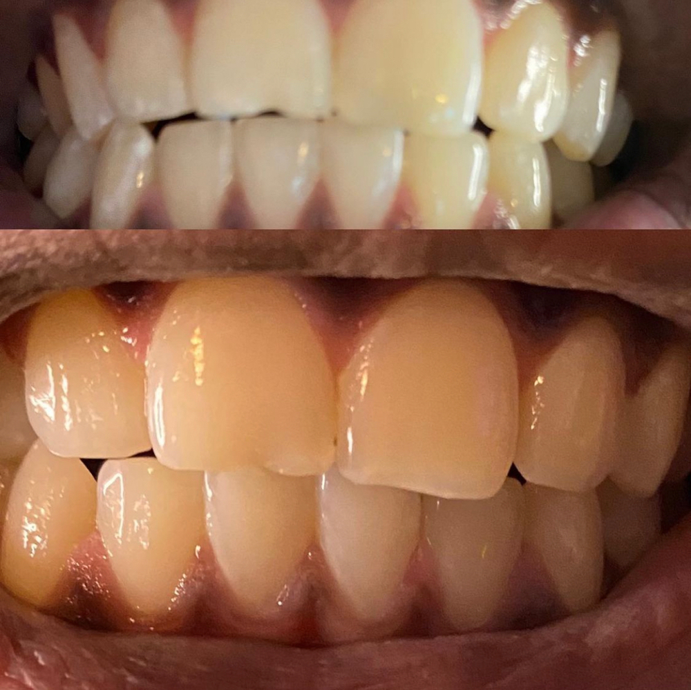 Teeth Whitening