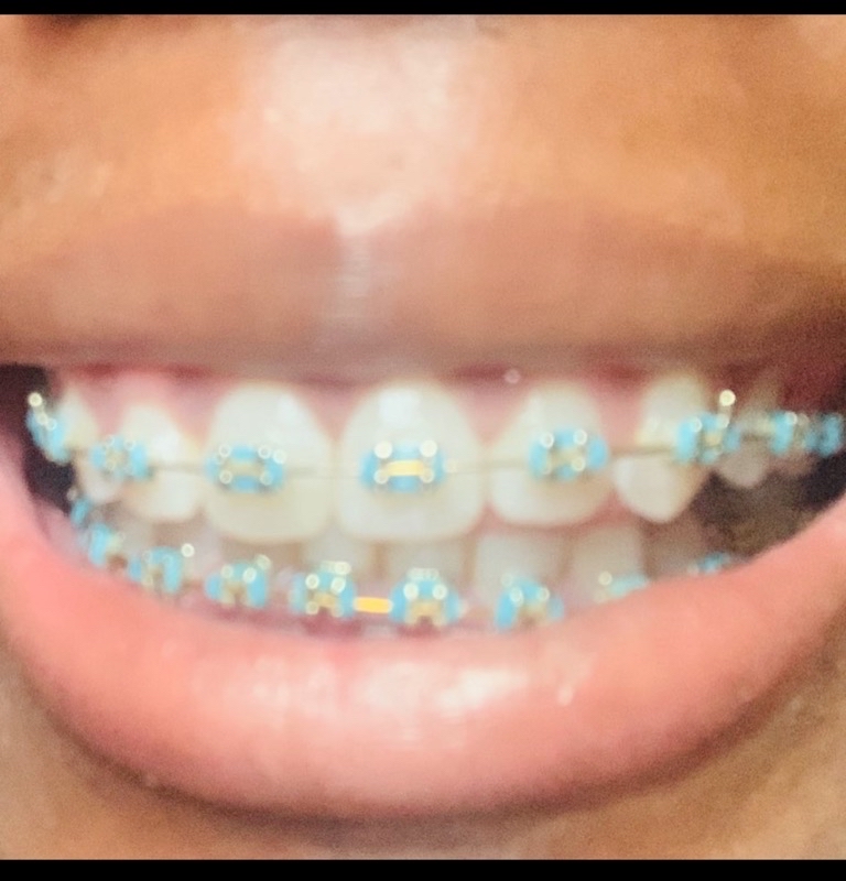 Gold Braces