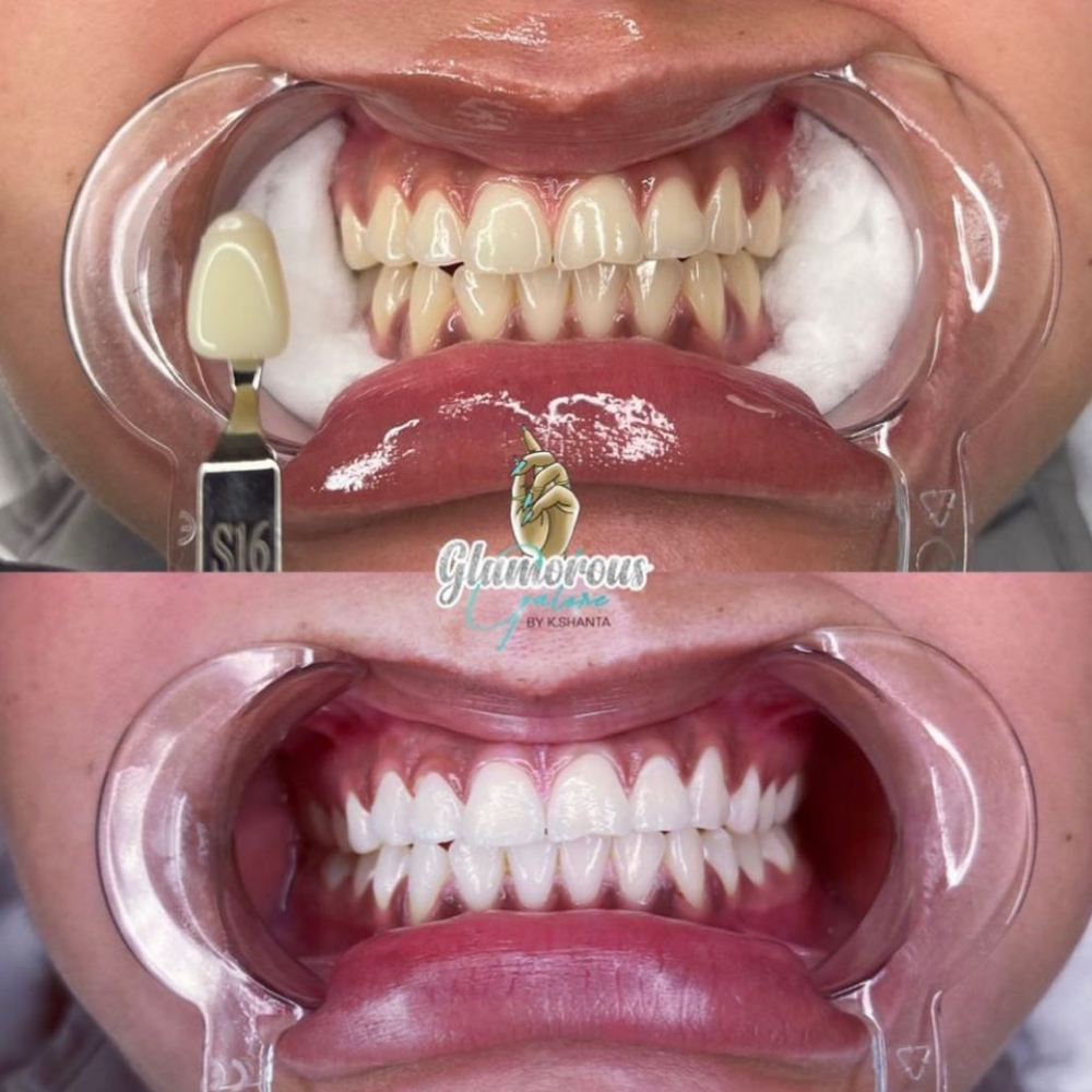 45 Minute Teeth Whitening