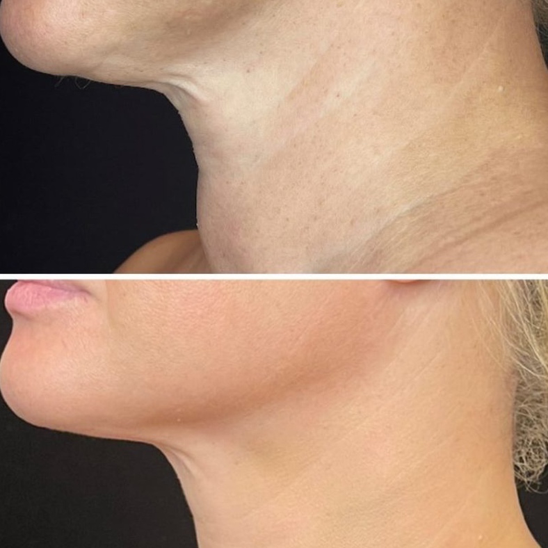 Ultherapy at Absolut Health and Wellness in Atlanta, GA