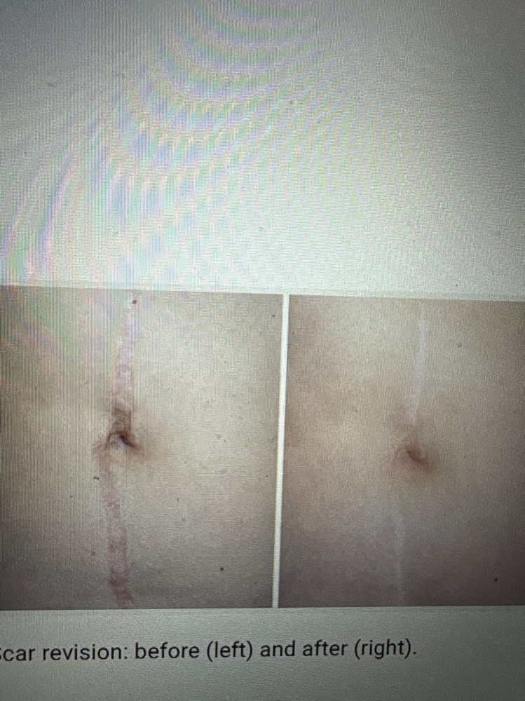 Scar Revision