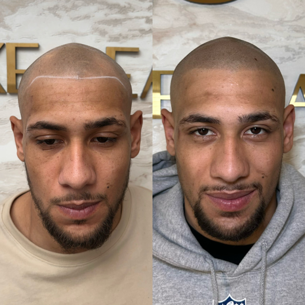Scalp Micropigmentation - SMP - at 🤍pSb Luxe Beauty🤍 in Tottenville, NY