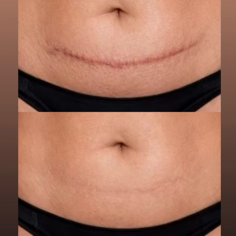 Mesotherapy For Stretch Marks at Holistic Beauty in View On Website, NY