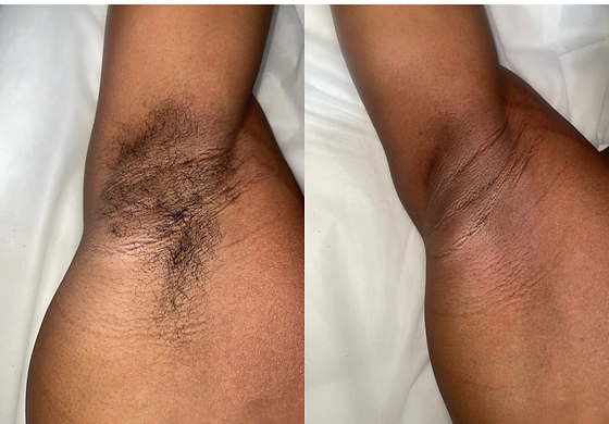 Underarms at The Diamanté Effect in Valley Stream, NY