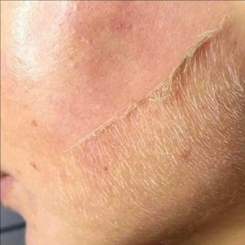 Dermaplaning at Sage Skin & Aesthetics in Kennewick, WA