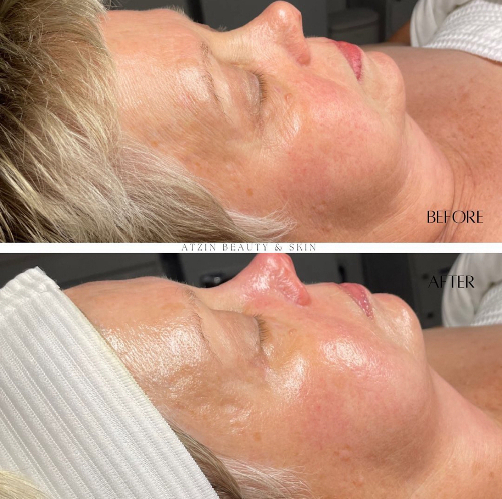 Complete Rejuvenated Facial