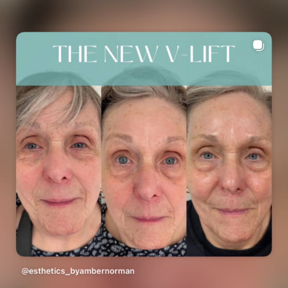 V Tox Facial at Pelle by Amber Norman in Starkville, MS