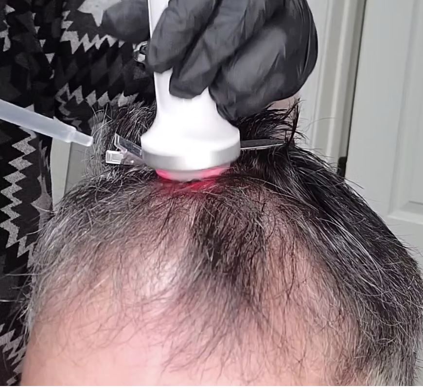 Noninvasive Hair Regrowth