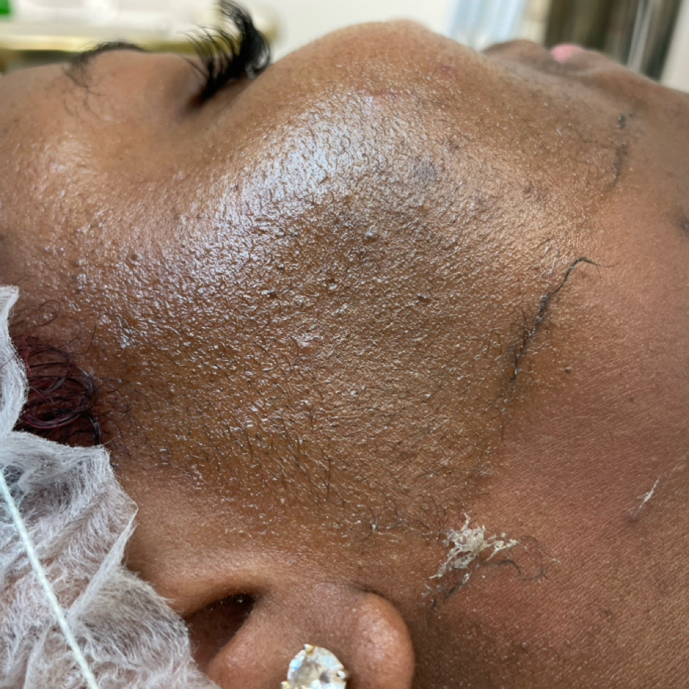 Deluxe Dermaplaning Facial at SKYNSENSE in Pikesville, MD