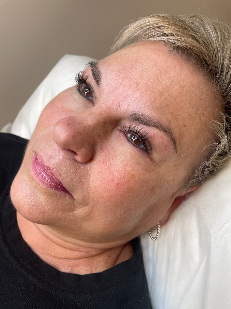 Upper Lashline Enhancement