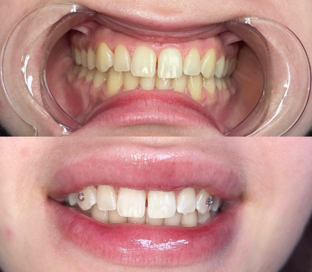 30 min Whitening + Swarovski Combo