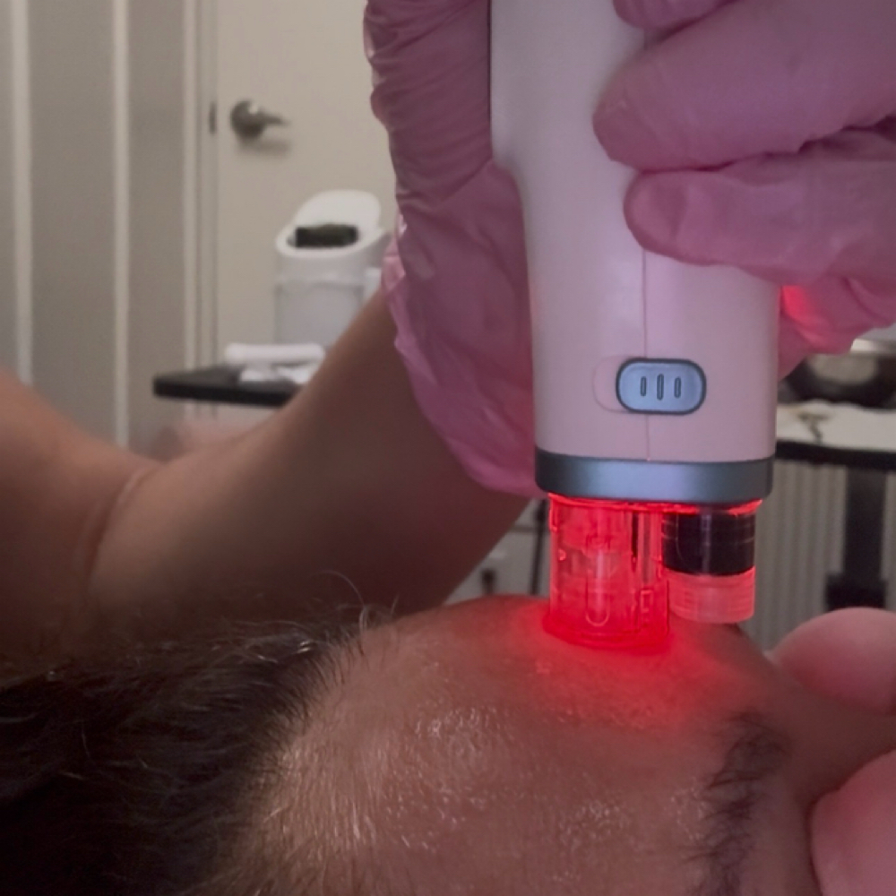 Add-On: Nano Needling at Aesthetics Artistry by Monica, LLC. in Dana Point, CA