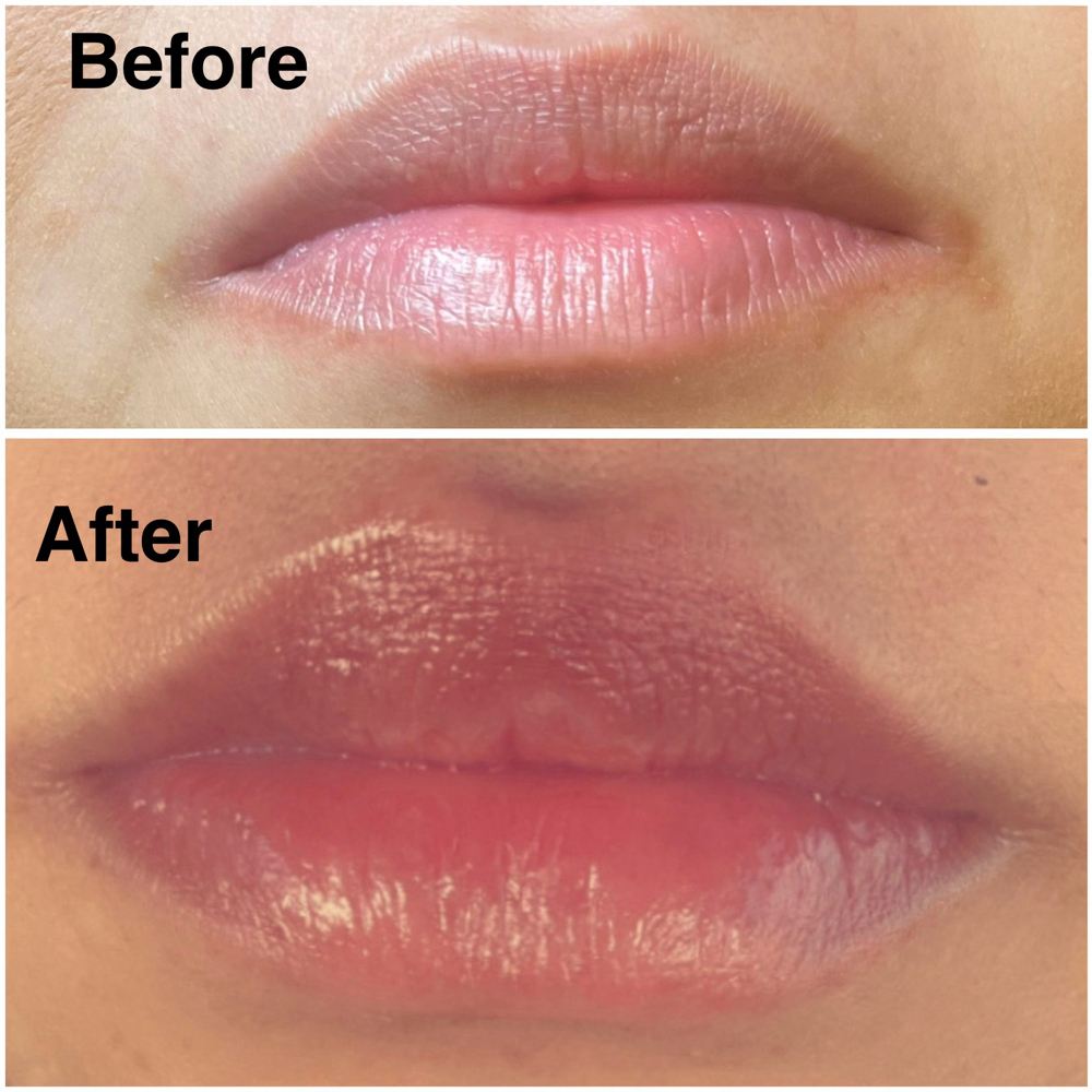 Lip Flips 💋 at Avana Aesthetics Med Spa in Weslaco, TX