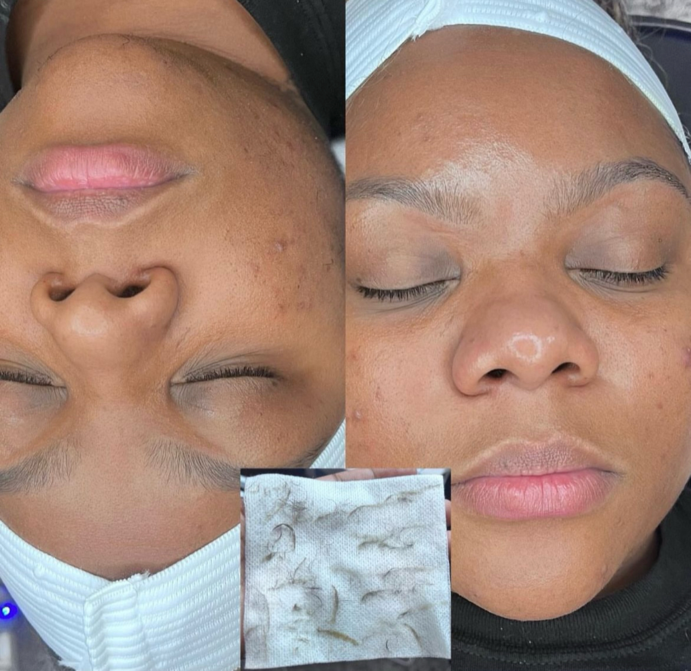 Dermaplane Facial