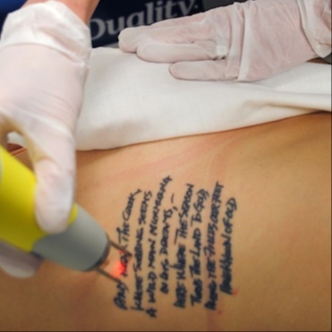 XS Laser Tattoo Removal Session