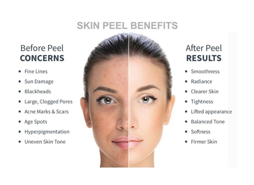 Chemical Peel Face To Neck