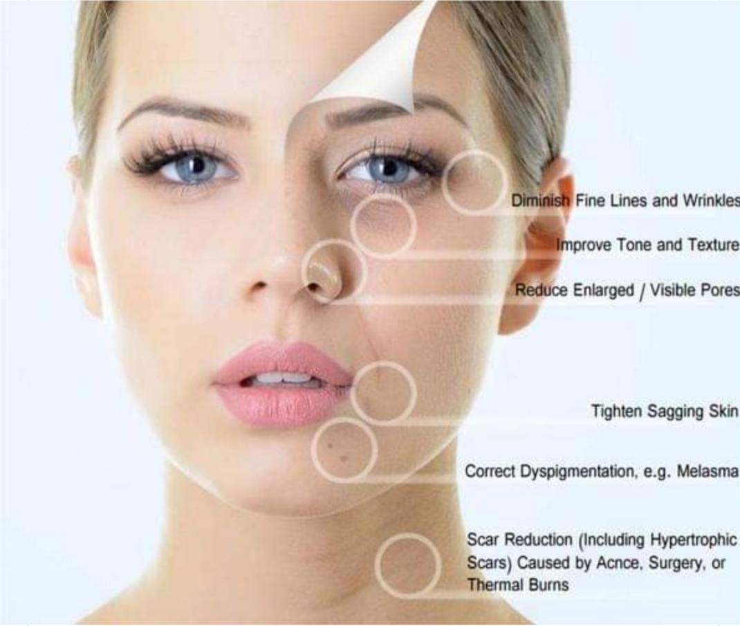 Microneedling W/Stem Cells