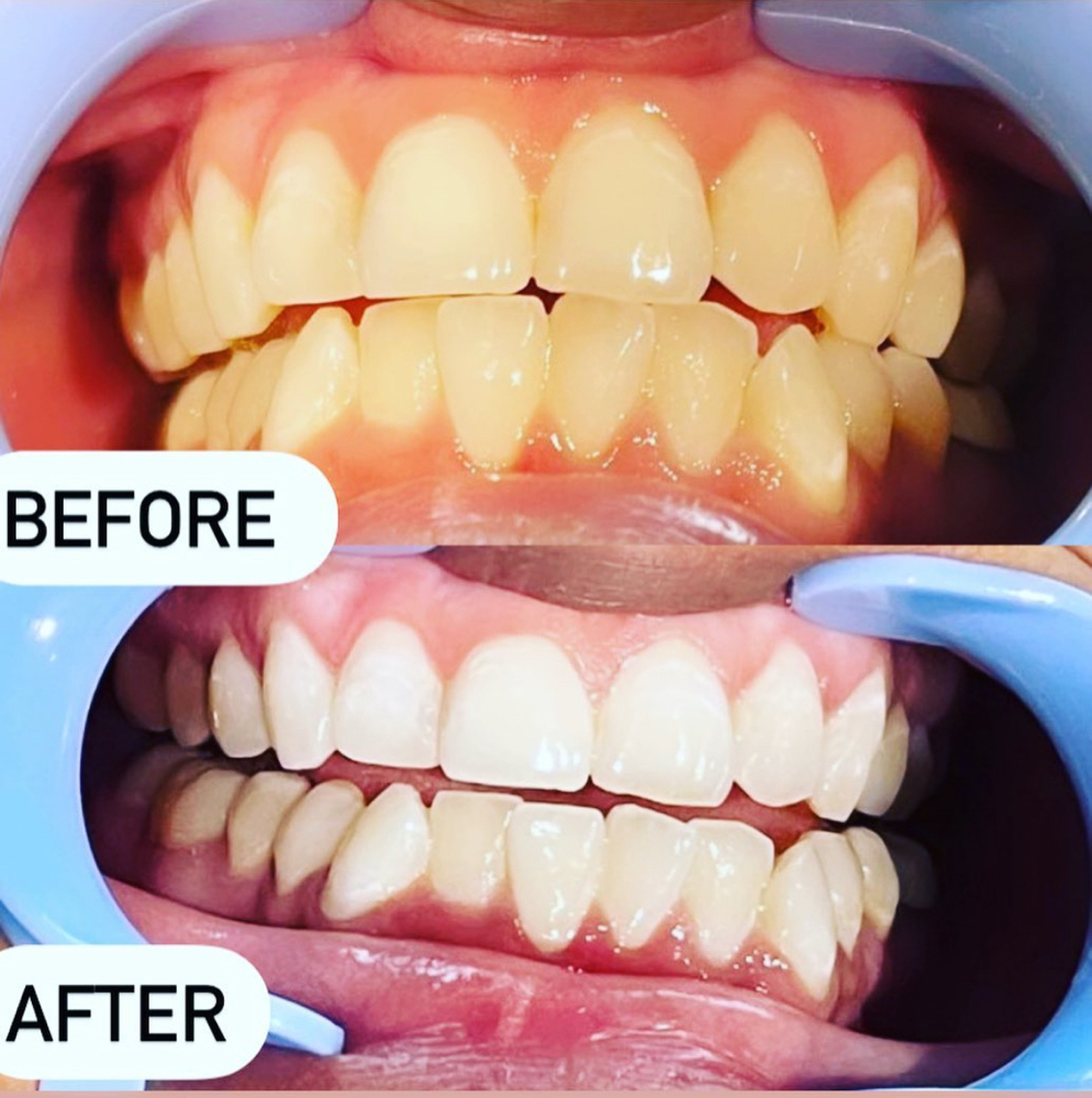 Teeth Whitening 80 Min at Linda’s Beauty Bar in Leander, TX