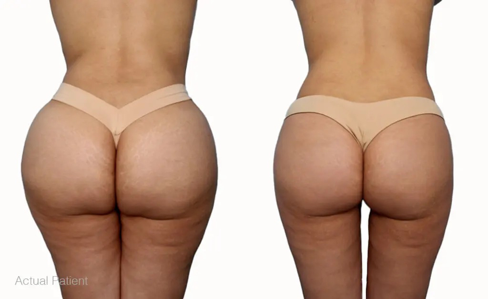 Liquid Brazilian Butt Lift Package