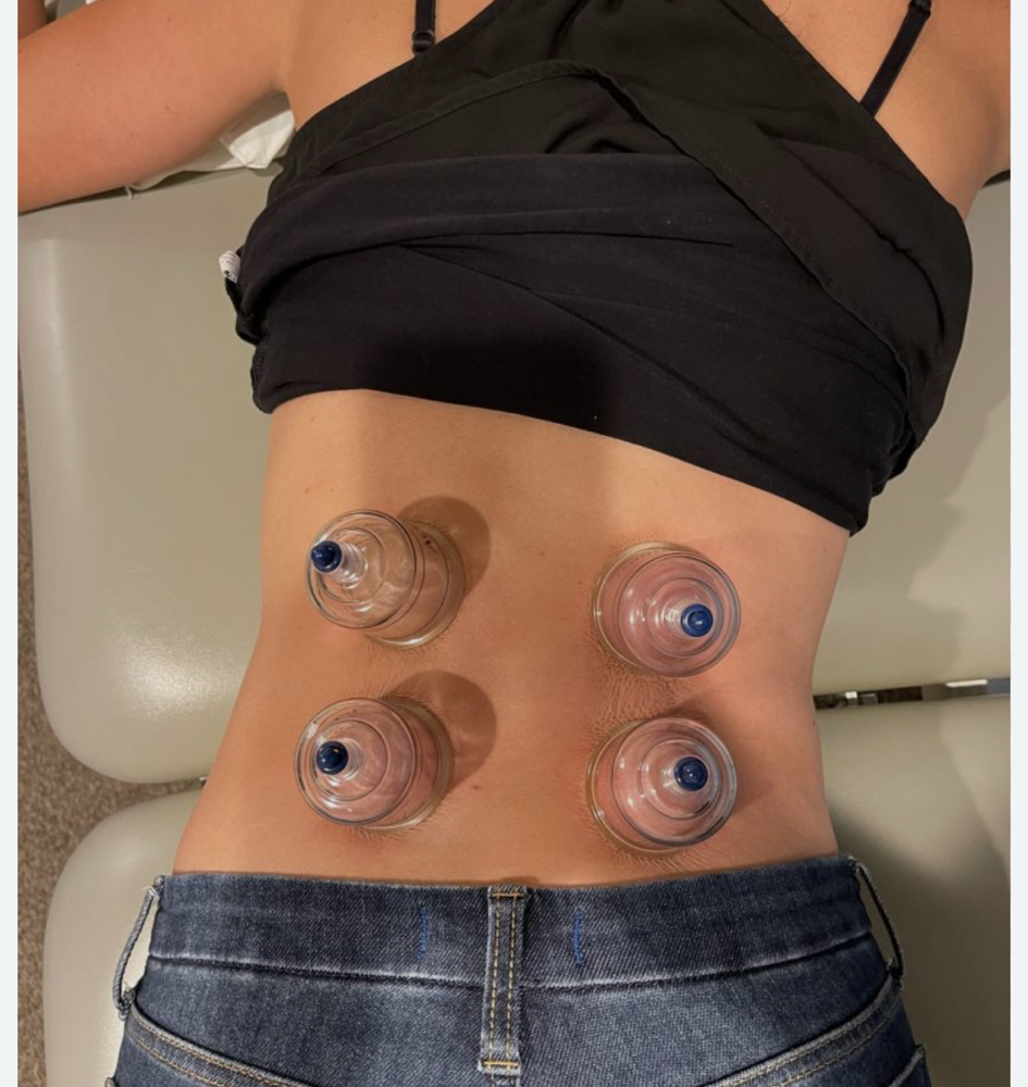 Cupping Therapy Add On