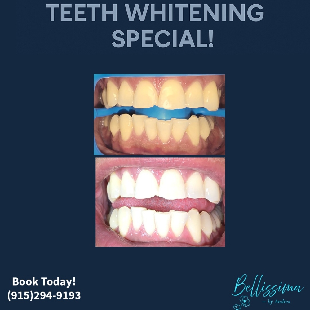 30 Min Couple TEETH WHITENING at Bellissima by Andrea in El Paso, TX