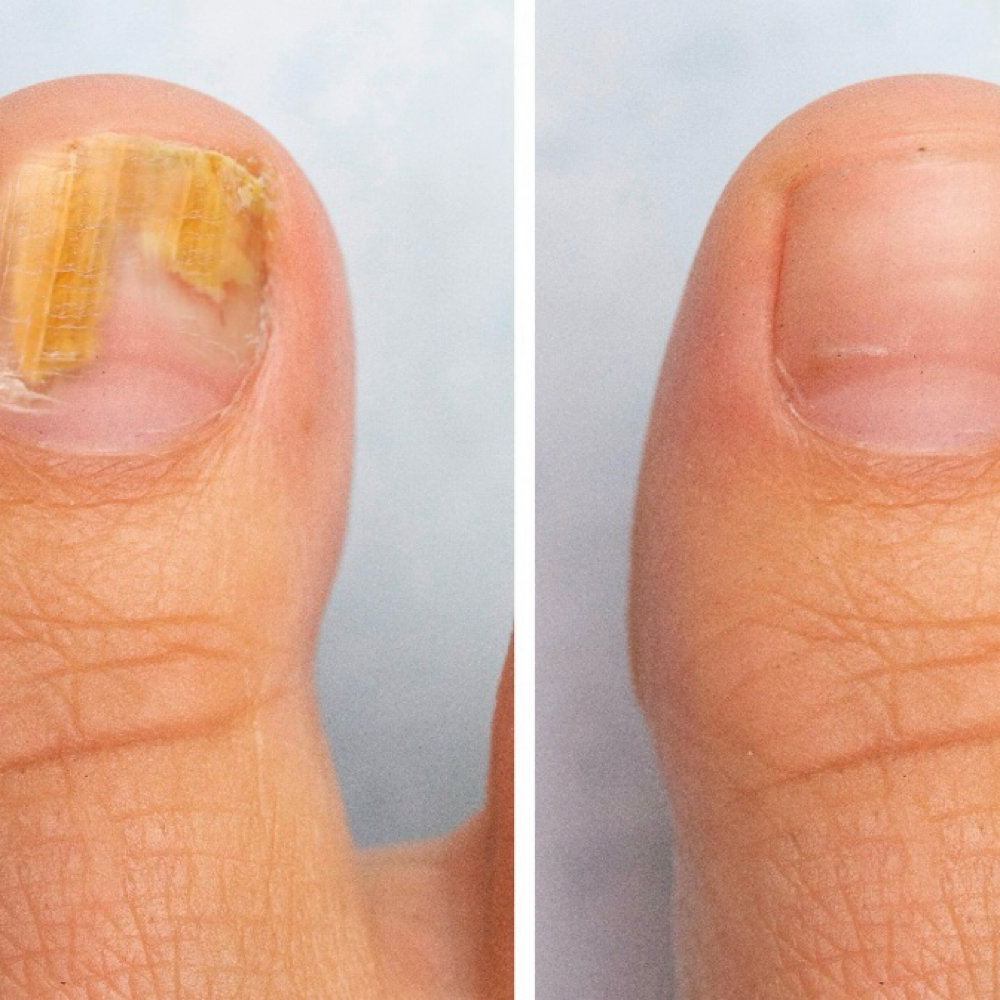 Onychomycosis (6) at La Belle Studio by Soraya in Woburn, MA