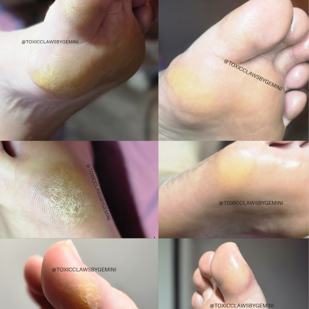 Callus Care